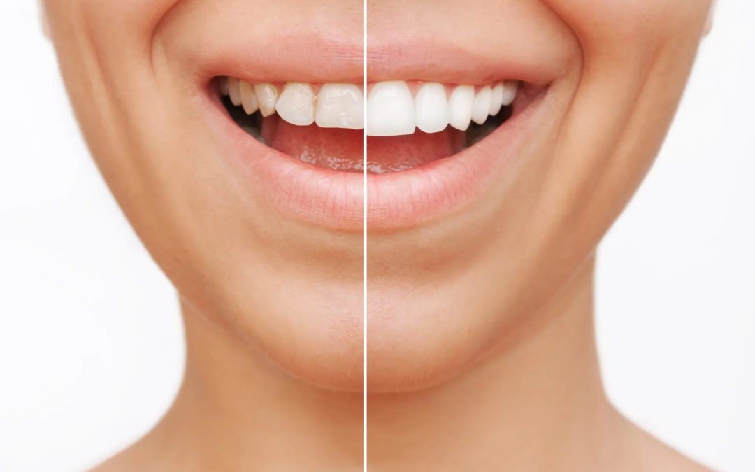 Coral Springs, FL Veneers Transform Your Smile